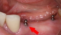 Mini Dental Implant to support & stabilize lower Denture